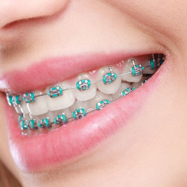 Braces