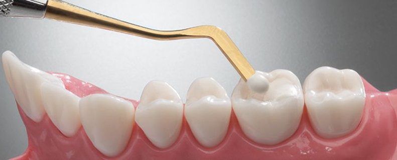 Dental Fillings