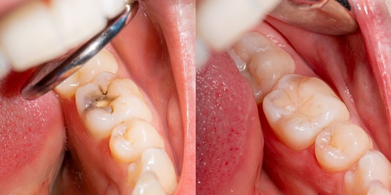 Dental Restoration